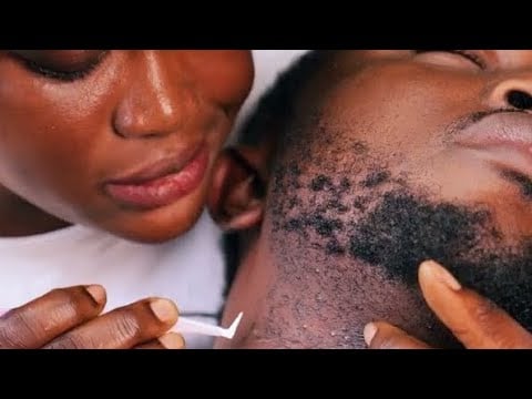 ASMR✨I Made Him Fall Asleep in 1 Minute 😴 Beard Grooming, Scratching, Shaving & Ingrown Hair Removal