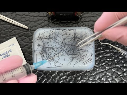 ASMR 인그로운 헤어 털뽑기 피부과 롤플레이 Dermatologist Ingrown Hair Removal RP