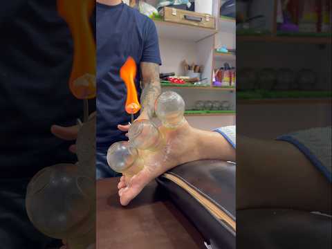 Heel spur treatment 😍😱#cupping #cuppingtherapy #fire #heel #shorts #youtubeshorts #explore