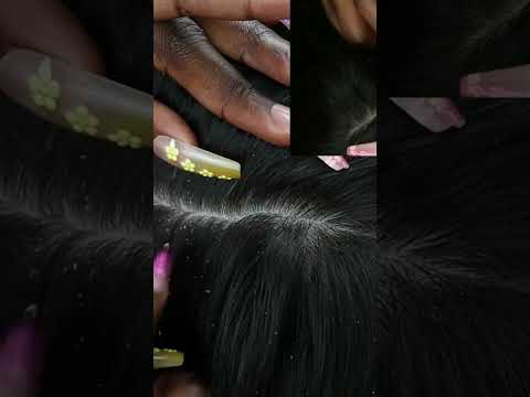 Dandruff scratching & removal #asmr #relax #fyp #foryoupage #viral #explorepage #nails #hair