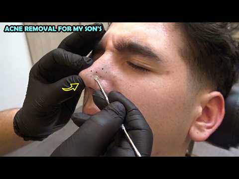 💈 I CLEARED MY SON'S TEENAGE ACNE REMOVAL + HAIRCUT + SKIN CARE + face,nose,ear,neck,eyebrow massage
