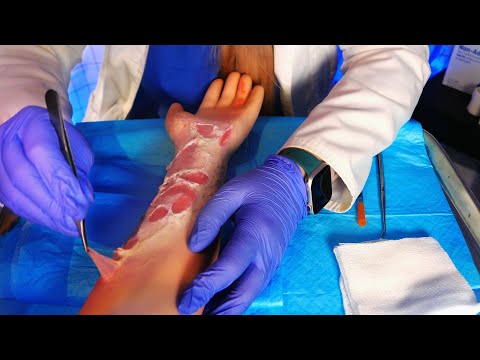 ASMR Hospital Skin Exam & Burn Treatment | Medical ASMR