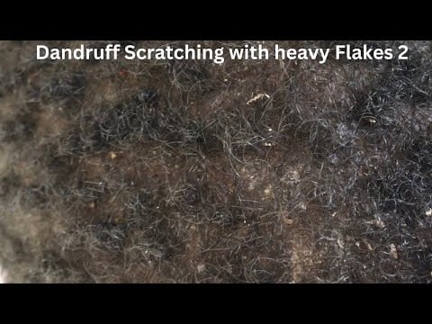 Asmr- Extreme Dandruff Scratching 2 | it’s Rains dandruff #asmr #dandruff