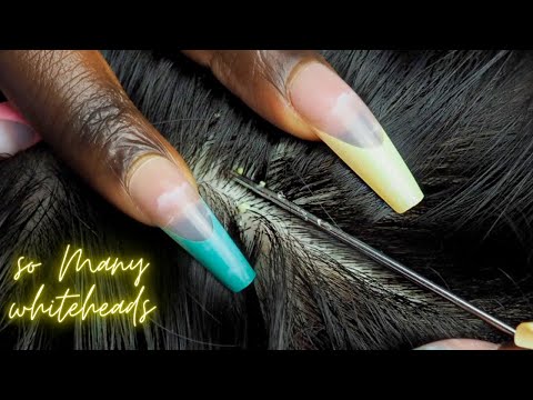 {ASMR} ATTENTIVE Scalp NITPICKING so many 😴 WHITEHEADS | super zoomed