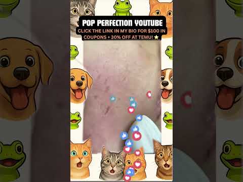 Wow! #pimpleremoval #pimple #pimples #shortsfeed #shortvideo #shorts #short #youtube #youtubeshorts