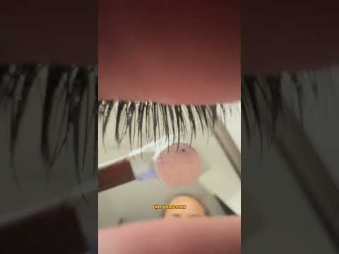 ASMR LIMPEZA DE CÓRNEA #asmr #cornea #cirurgia