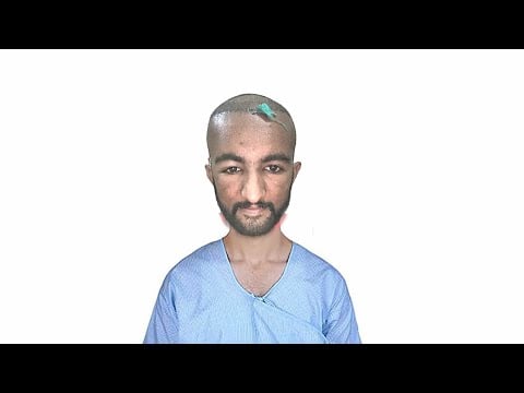 ASMR MY HAIRTRANSPLANT HEAD WASH 🧼 