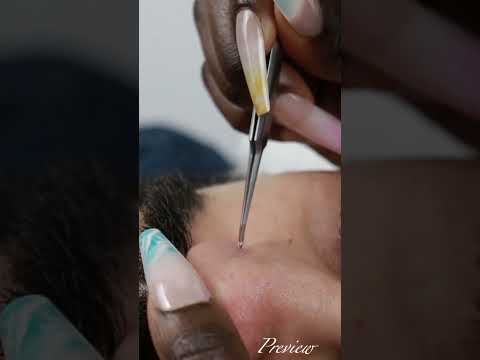 Picking hair and stuff from his nose | full video uploaded on our channel #asmr #shortsvideo #shorts