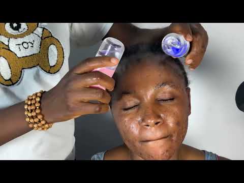 ASMR FACE NITPICKING AND CLEANING, PIMPLE POPPING FOR SLEEP VERY SATISFYING