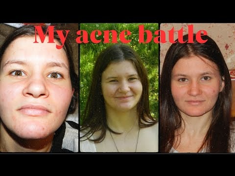 One battle after another: Acne, Anxiety, Acceptance. My skin story. (Russain accent softspoken)