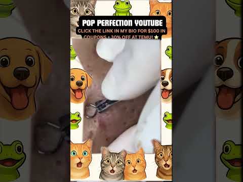 Wow! #pimpleremoval #pimple #pimples #shortsfeed #shortvideo #shorts #short #youtube #youtubeshorts