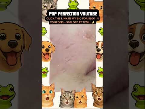 Wow! #pimpleremoval #pimple #pimples #shortsfeed #shortvideo #shorts #short #youtube #youtubeshorts