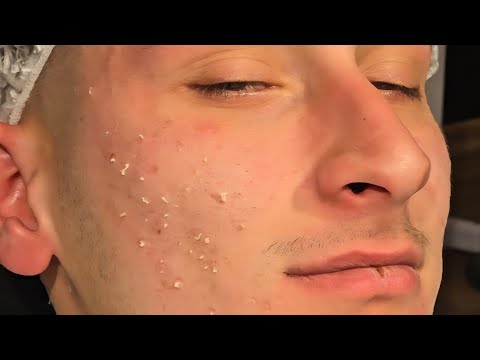 NO ADS 🚫 The Most Relaxing Blackhead & Acne Treatment Ever (ASMR)