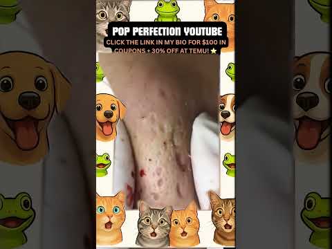 Wow! #pimpleremoval #pimple #pimples #shortsfeed #shortvideo #shorts #short #youtube #youtubeshorts