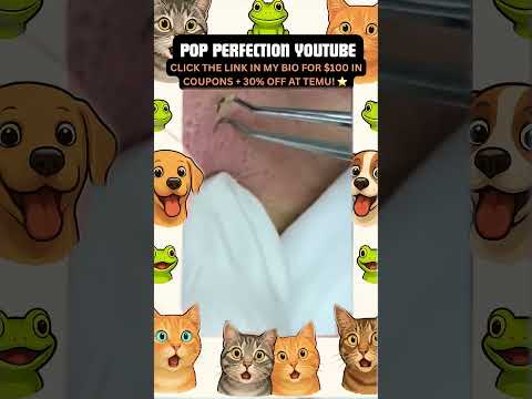 Wow! #pimpleremoval #pimple #pimples #shortsfeed #shortvideo #shorts #short #youtube #youtubeshorts