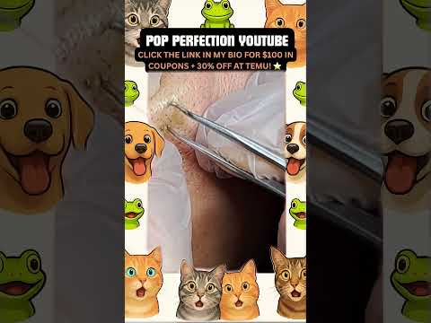 Wow! #pimpleremoval #pimple #pimples #shortsfeed #shortvideo #shorts #short #youtube #youtubeshorts