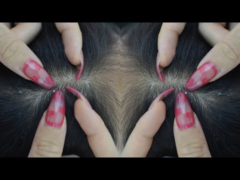 ASMR Scalp Check For Sleep, Scalp Scratching Tingles For Headache Relief ( No Talking )