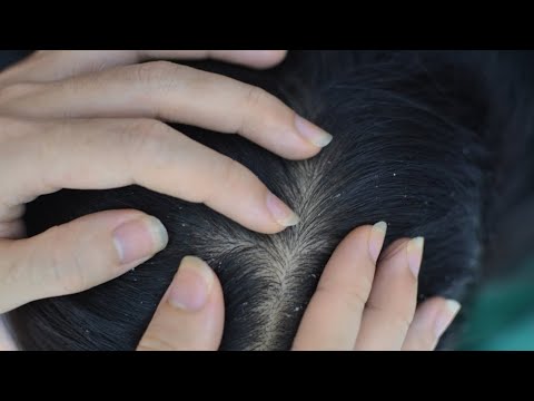 ASMR Scalp Check, Scalp Scratching Sounds Therapy For Deep Sleep ( No Talking )