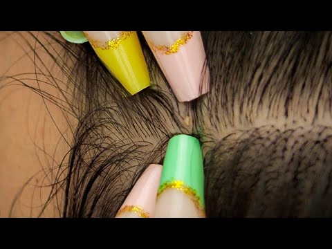 ASMR | Close ATTENTIVE & Tingly Nitpicking Whiteheads ~ soft whispers 😴