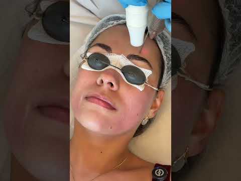 ASMR Fazendo Laser Fotona #asmr #laser #fotona #shorts