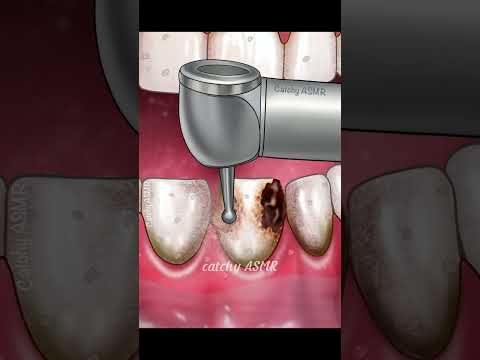 Rotten tooth repair animation, ASMR animation, relaxing cavity filling treatment animation,