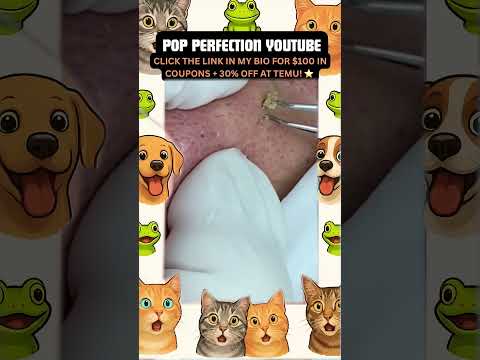 Wow! #pimpleremoval #pimple #pimples #shortsfeed #shortvideo #shorts #short #youtube #youtubeshorts