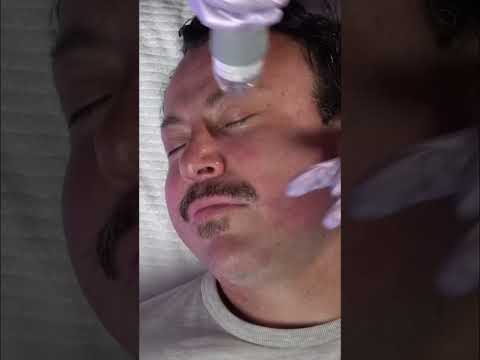 RF Microneedling: The Spicy Truth Behind Tight, Glowing Skin! #shorts
