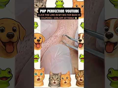 Wow! #pimpleremoval #pimple #pimples #shortsfeed #shortvideo #shorts #short #youtube #youtubeshorts