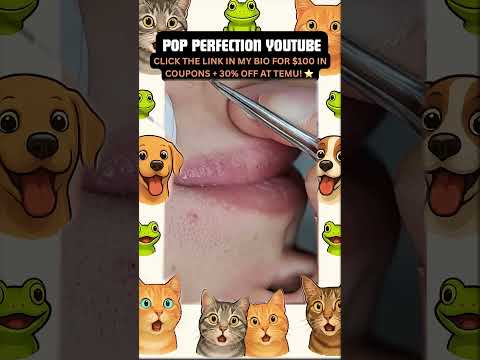 Wow! #pimpleremoval #pimple #pimples #shortsfeed #shortvideo #shorts #short #youtube #youtubeshorts