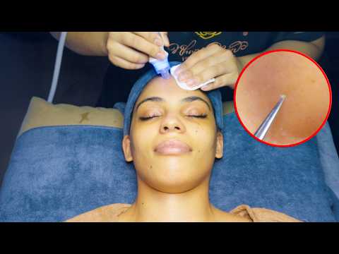 ASMR: Satisfying Acne Removal & Vacuum Facial Massage Treatment in Vietnam