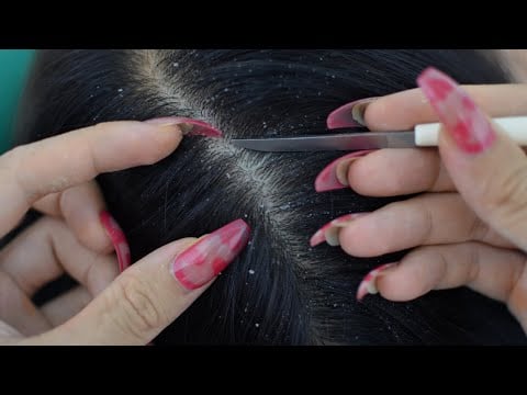 ASMR Dandruff Scratching On Black Long Hair,  Dandruff Removal And Treatment For Relaxation
