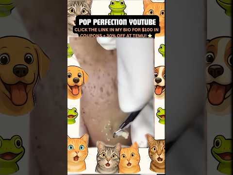 Wow! #pimpleremoval #pimple #pimples #shortsfeed #shortvideo #shorts #short #youtube #youtubeshorts