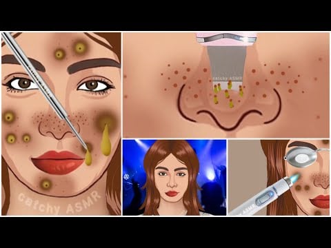 Night party make-up allergic reaction animation || Acne and pimple treatment animation ASMR