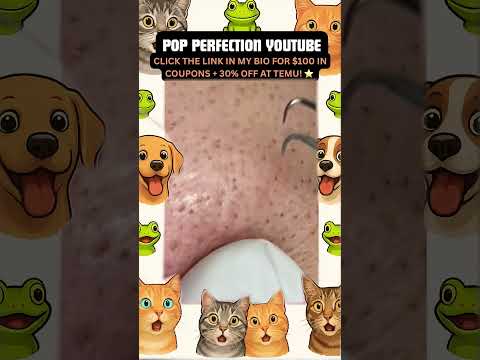 Wow! #pimpleremoval #pimple #pimples #shortsfeed #shortvideo #shorts #short #youtube #youtubeshorts