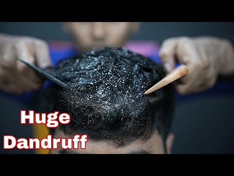 Huge Dandruff Removal From Dry Sculp | ASMR Dandruff Treatment & Massage | Dandruff Scratching ASMR