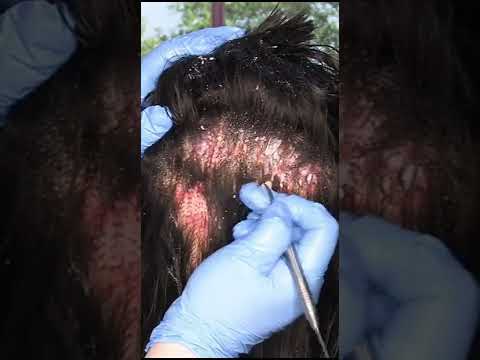 ASMR Scalp Check with Bad Results #shorts