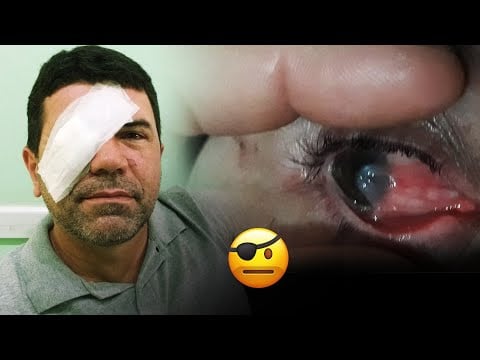 DIÁRIO DE CIRURGIA DO PTERÍGIO | ANTES E DEPOIS