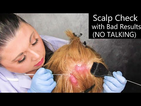 ASMR Scalp Check with Bad Results (NO TALKING, Scalp Treatment, Dandruff Removal) Medical Roleplay