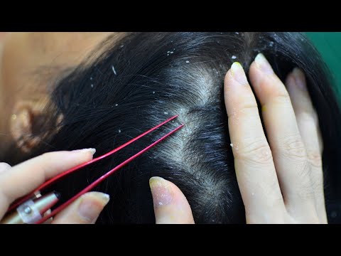 ASMR Scalp Check / Tweezers  / Scalp Scratching Fast And Aggressive Relaxing For Sleep
