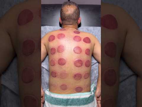 wow asmr cupping🍕❤️#cupping #asmr #explore #shorts #cuppingtherapy #youtubeshorts #fire