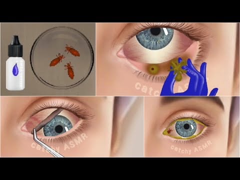 Eye louse infection treatment animation ASMR || Eye worm treatment animation.