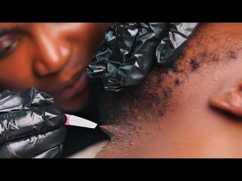 ASMR Intense Beard Scratching & Neck Massage (Ingrown Hair Removal + Nitpicking)4 Deep Sleep. No Gum