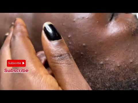 ASMR DEEP EAR-PICKING & CLEANING-VERY SATISFYING 🥰😴