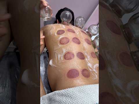 pizza cupping😍#cuppingtherapy #cupping #relax #massage #asmr #shorts #trendingshorts #viralshorts