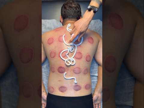 wow asmr fom cupping😍#shorts #cupping#asmr #massage #viral #cuppingtherapy