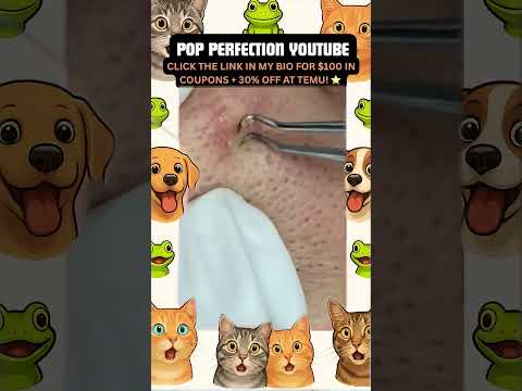 Wow! #pimpleremoval #pimple #pimples #shortsfeed #shortvideo #shorts #short #youtube #youtubeshorts