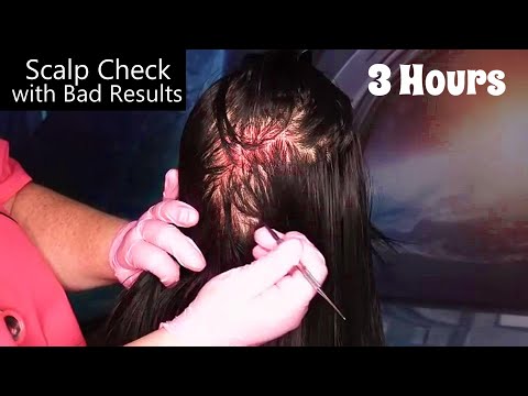 ASMR Scalp Check with Bad Results Compilation (Scalp Treatment, Whispering) Medical Roleplay