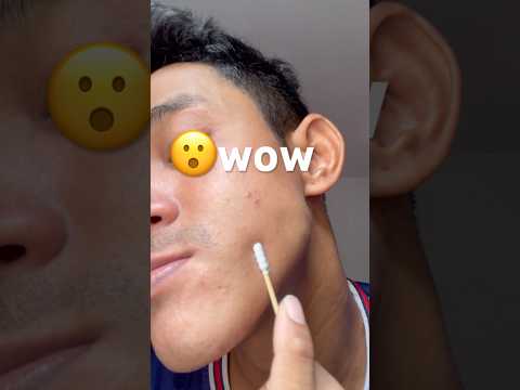 Wow! #pimpleremoval #pimple #pimples #shortsfeed #shortvideo #shorts #short #youtube #youtubeshorts