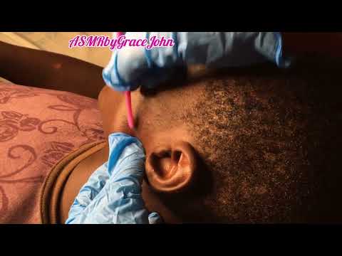 Popping my brother’s pimples while he fell asleep.#asmr #pimplesremoval #acene #satisfying