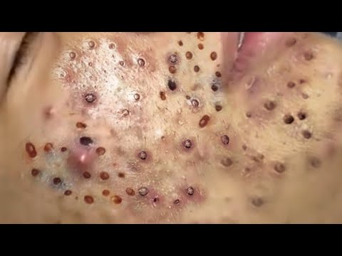 حلول طبيعية لبشرة صافية# 𝐒𝐤𝐢𝐧 𝐂𝐚𝐫𝐞 56631